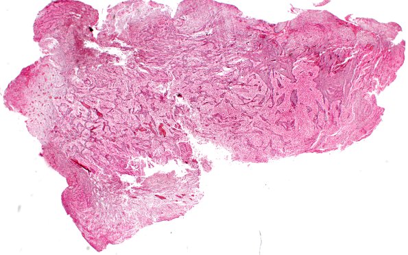 23A3 Gliosarcoma (Case 23) Retic 2X
