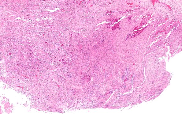 23A4 Gliosarcoma (Case 23) H&E Area A 10X 1