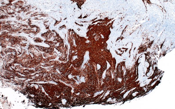 23A5 Gliosarcoma (Case 23) GFAP Area A 10X 1 - Copy