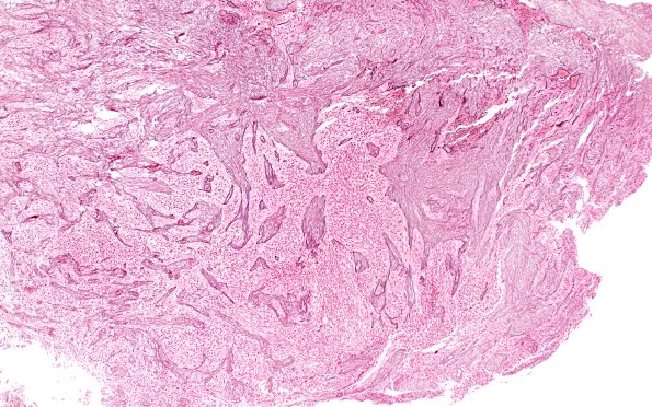 23A6 Gliosarcoma (Case 23) Retic Area A 10X 1