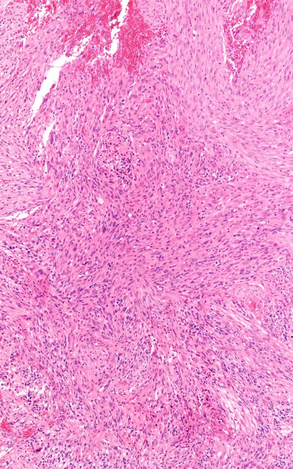 23A7 Gliosarcoma (Case 23) H&E 10X 2