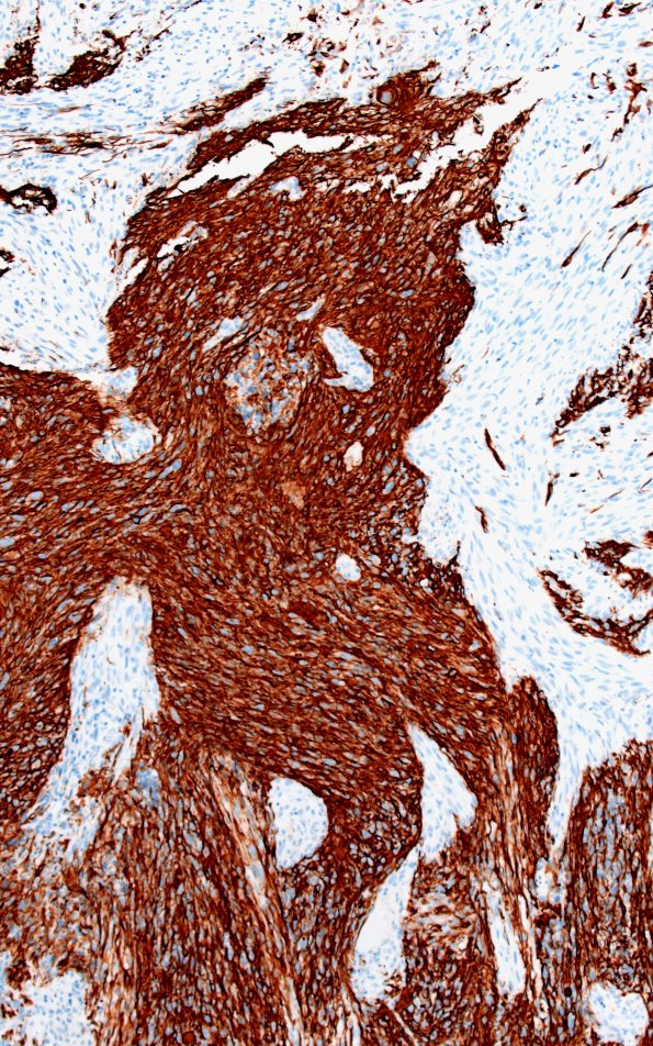 23A8 Gliosarcoma (Case 23) GFAP 10X A
