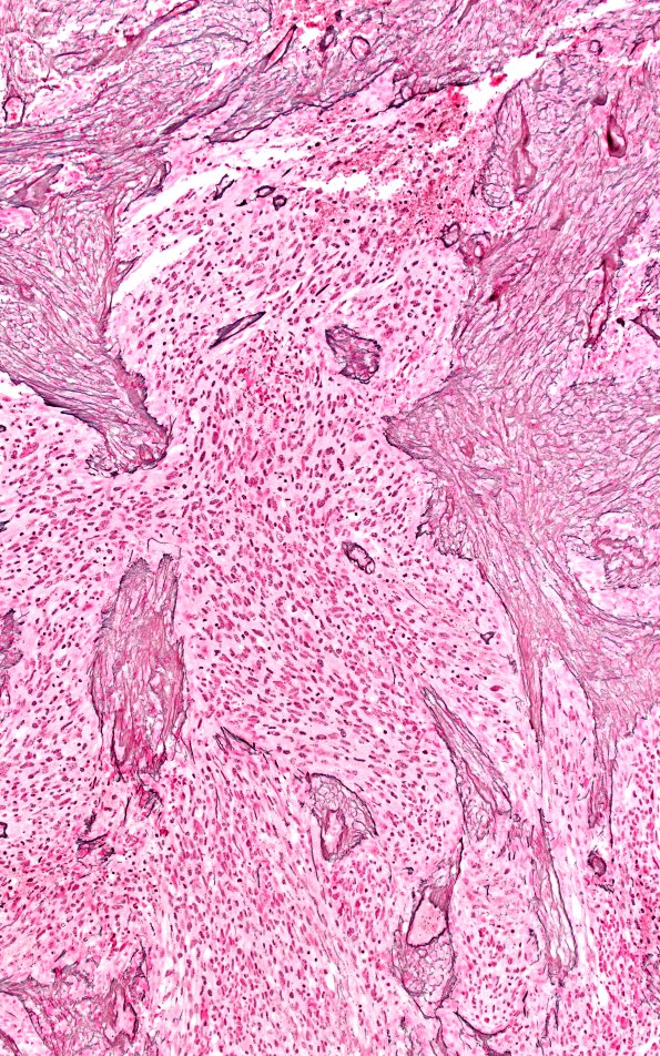 23A9 Gliosarcoma (Case 23) Retic 10X A