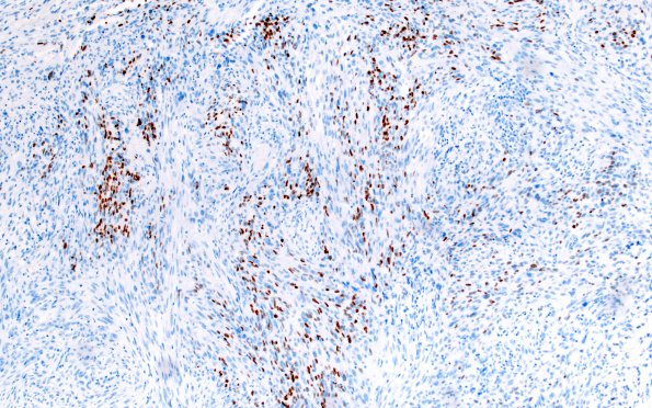 23B Gliosarcoma (Case 23) Olig2 20X 2