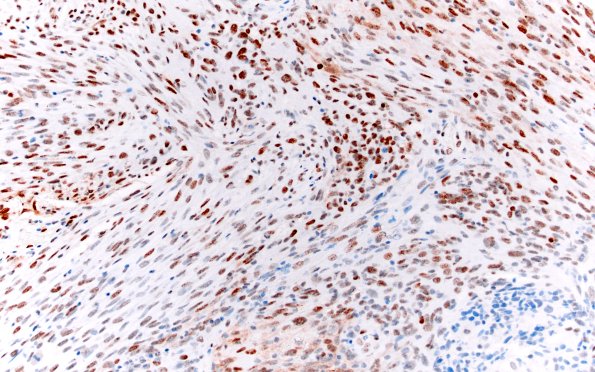 23C Gliosarcoma (Case 23) p53 20X 2