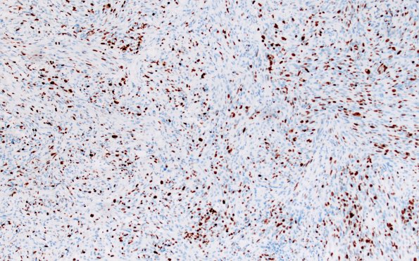 23D Gliosarcoma (Case 23) Ki67 10X 2