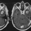 2A Gliosarcoma (Case 2) - Copy