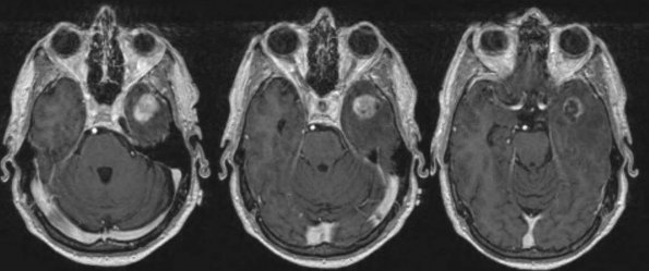 2A Gliosarcoma (Case 2) - Copy