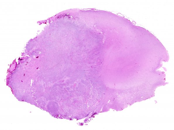 2B1 Gliosarcoma (Case 2) 1 H&E whole mount