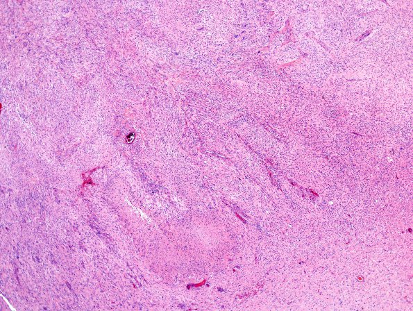 2B2 Gliosarcoma (Case 2)  H&E 6