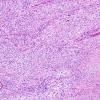 2B3 Gliosarcoma (Case 2)  H&E 8