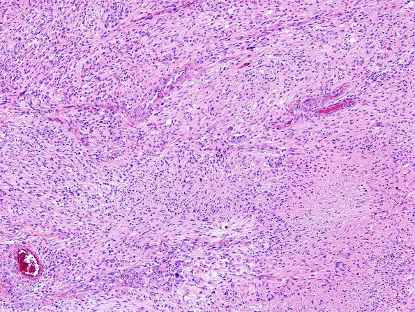 2B3 Gliosarcoma (Case 2)  H&E 8