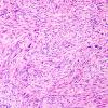 2B4 Gliosarcoma (Case 2)  H&E 2