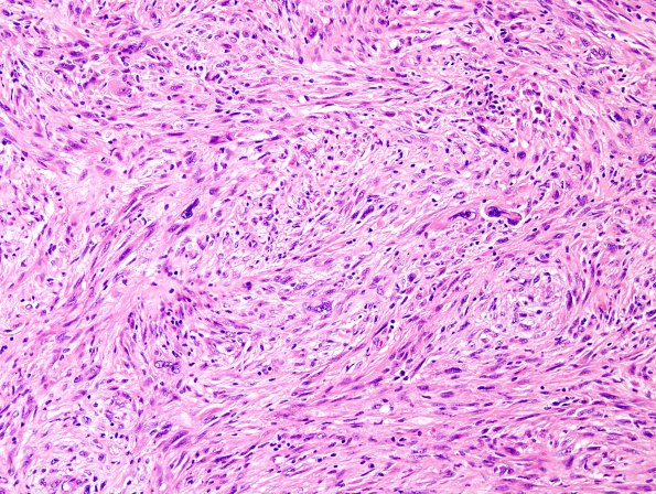 2B4 Gliosarcoma (Case 2)  H&E 2