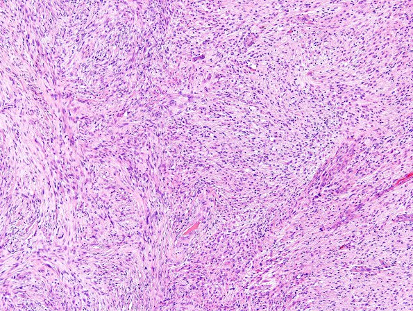 2B5 Gliosarcoma (Case 2)  H&E 7