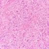 2B6 Gliosarcoma (Case 2)  H&E 20X