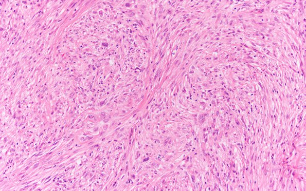 2B6 Gliosarcoma (Case 2)  H&E 20X