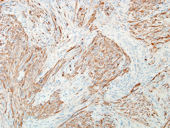 2C3 Gliosarcoma (Case 2)  GFAP 2