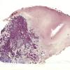 2D1 Gliosarcoma (Case 2) 1 Retic whole mount