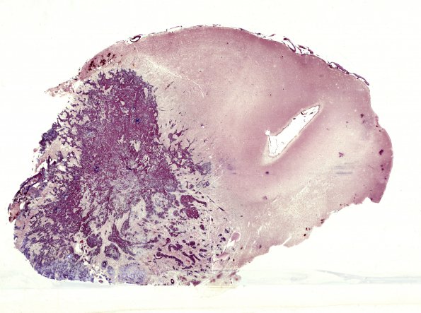 2D1 Gliosarcoma (Case 2) 1 Retic whole mount