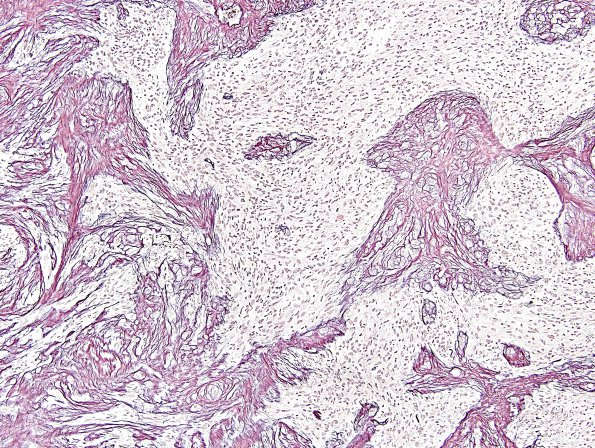 2D3 Gliosarcoma (Case 2)  Retic 3