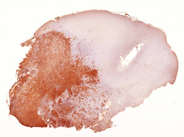 2E1 Gliosarcoma (Case 2) 1 SMA whole mount