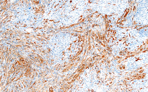 2E3 Gliosarcoma (Case 2)  SMA 10X