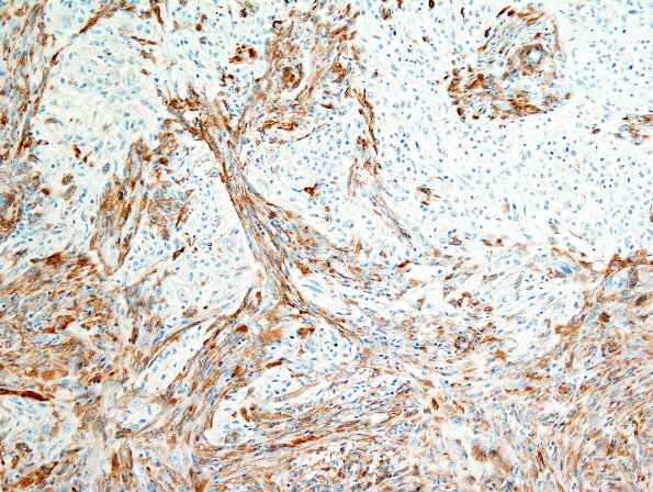 2E3 Gliosarcoma (Case 2)  SMA 6