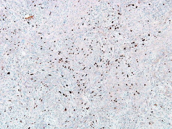 2F2 Gliosarcoma (Case 2)  Ki67 1