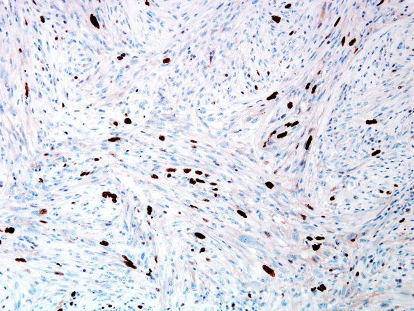 2F3 Gliosarcoma (Case 2)  Ki67 2