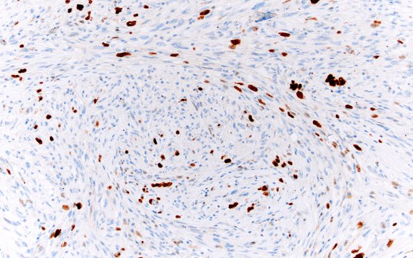 2F4 Gliosarcoma (Case 2) 1 Ki67 20X