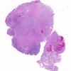 3A1 Gliosarcoma-PNET-Adenoid var (Case 3) H&E whole mount