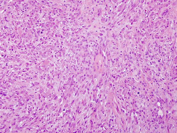 3A2 Gliosarcoma-PNET-Adenoid var (Case 3) H&E label B