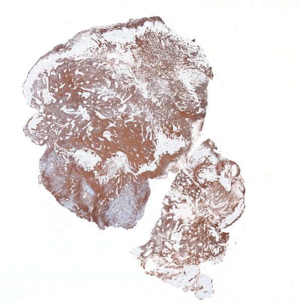 3B1 Gliosarcoma-PNET-Adenoid var (Case 3) GFAP whole mount