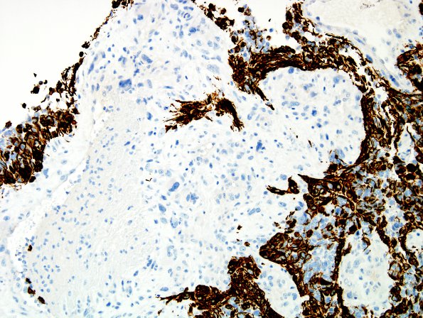 3B2 Gliosarcoma-PNET-Adenoid var (Case 3) GFAP label F3