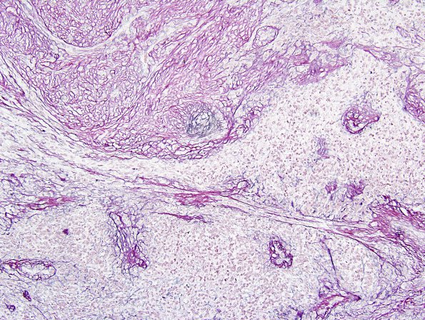 3C2 Gliosarcoma-PNET (Case 3) Reticulin 1.jpg