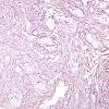 3C3 Gliosarcoma-PNET-Adenoid var (Case 3) Retic label C