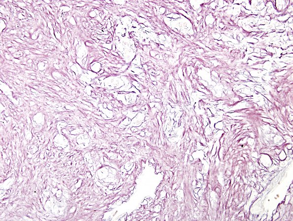 3C3 Gliosarcoma-PNET-Adenoid var (Case 3) Retic label C