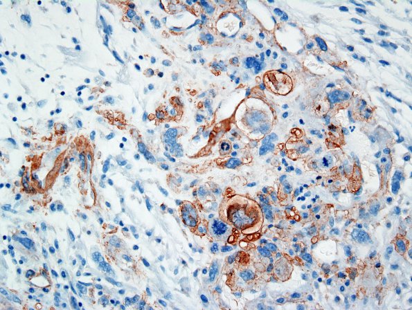 3D Gliosarcoma-PNET (Case 3) SMA 1.jpg