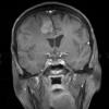 4A1 Gliosarcoma (Case 4) T1 Post with contrast 1 - Copy