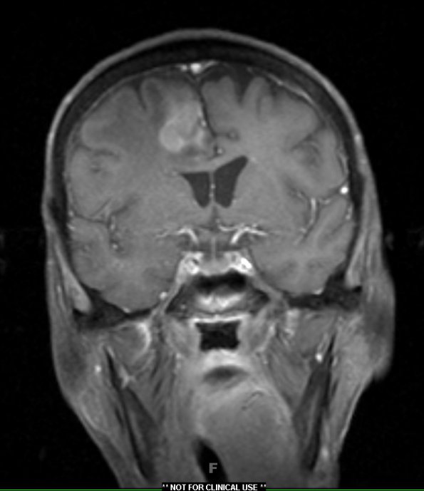 4A1 Gliosarcoma (Case 4) T1 Post with contrast 1 - Copy