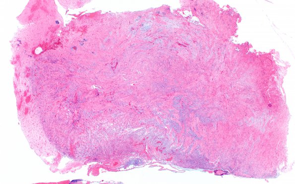 4B1 Gliosarcoma, chondroid and osteoid (Case 4) H&E 2X Area 1