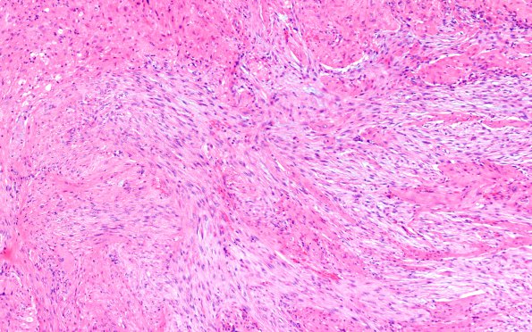 4B2 Gliosarcoma, chondroid and osteoid (Case 4) H&E 10X 2