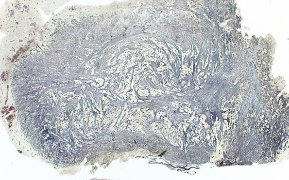 4D Gliosarcoma, chondroid and osteoid (Case 4) Retic 2X Area 1