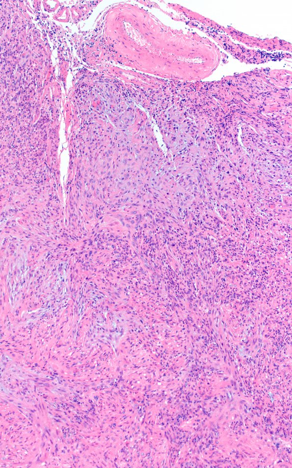 4E1 Gliosarcoma, chondroid and osteoid (Case 4) area 5 H&E 10X