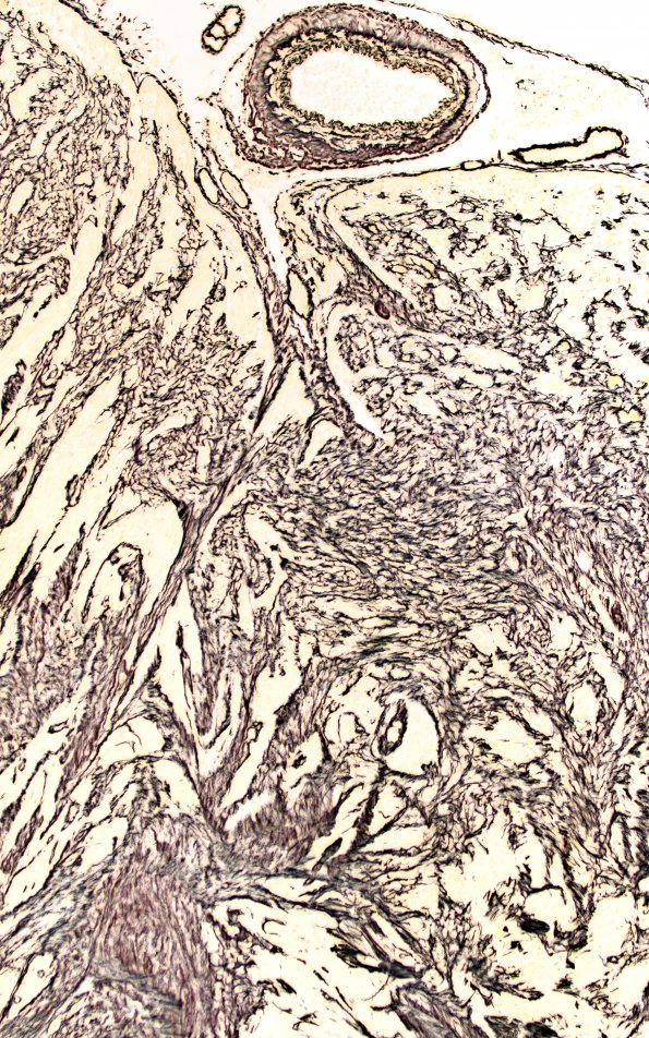 4E3 Gliosarcoma, chondroid and osteoid (Case 4) area 5 Retic 10X