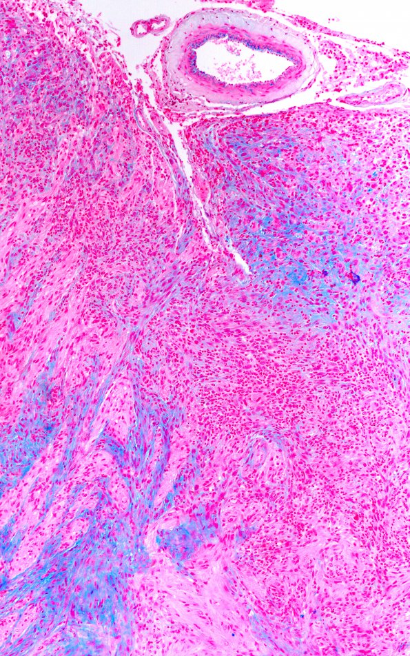 4E4 gliosarcoma, chondroid and osteoid (Case 4) area 5 AB 10X