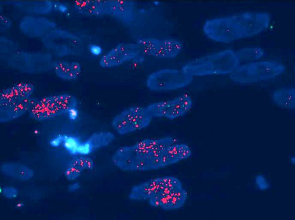 4F1 Gliosarcoma (Case 4) EGFR (red) 1 - Copy