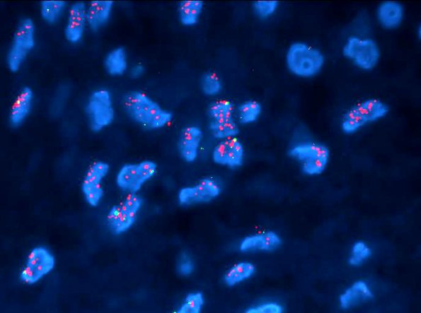 4F2 Gliosarcoma (Case 4) EGFR (red) 2 - Copy