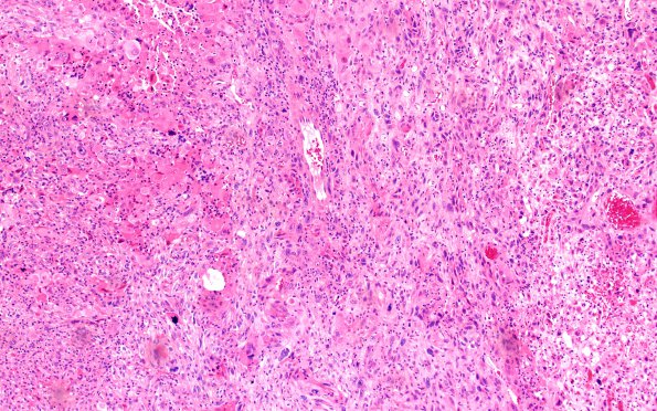 5A1 Gliosarcoma (Case 5) H&E 10X